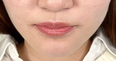 Facial Liposuction_after