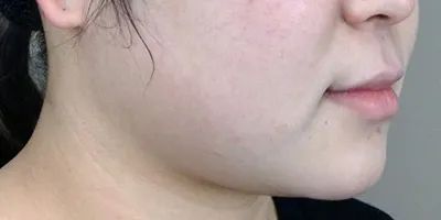 Facial Liposuction_before