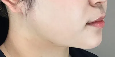 Facial Liposuction_after