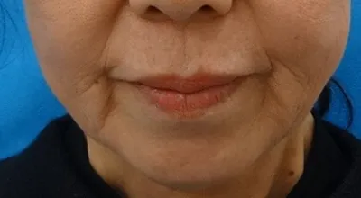Surgical Facelift_before