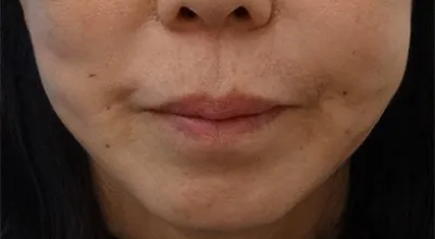 Surgical Facelift_after