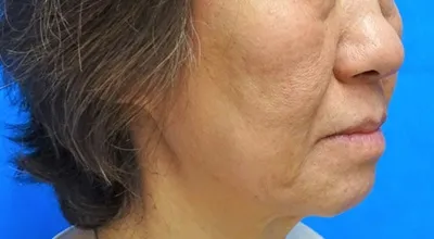 Surgical Facelift_before