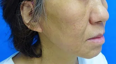 Surgical Facelift_after
