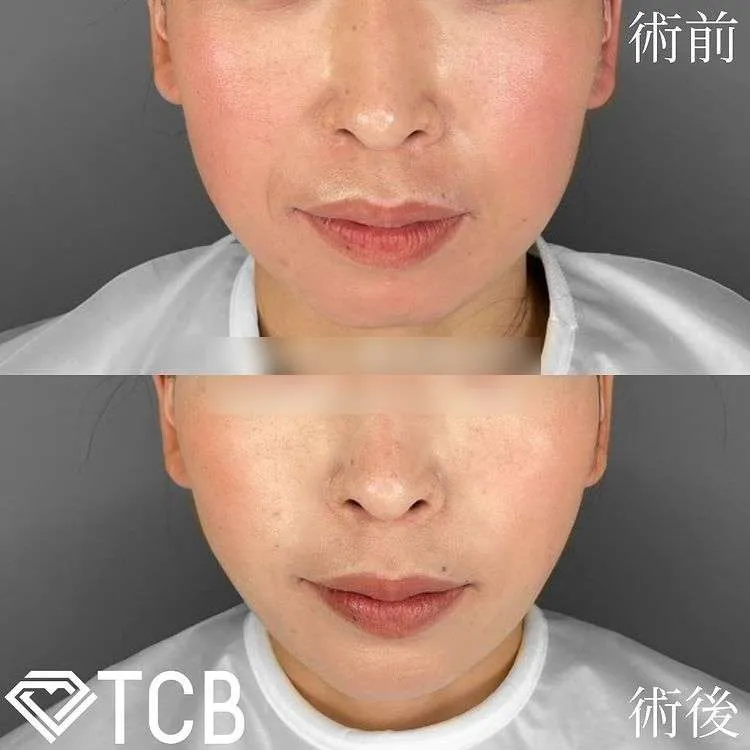 TCB Small Face Lift