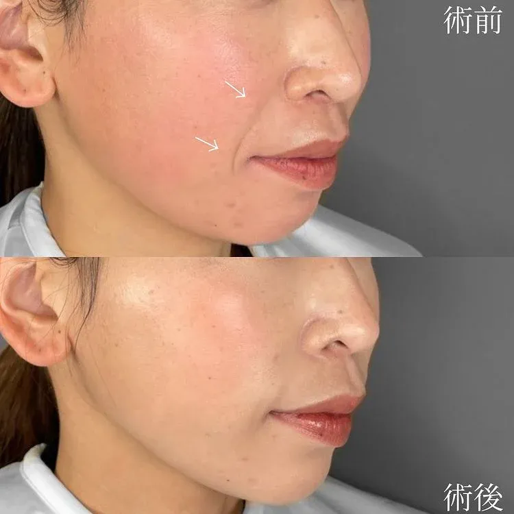 Medical HIFU (HIFU)