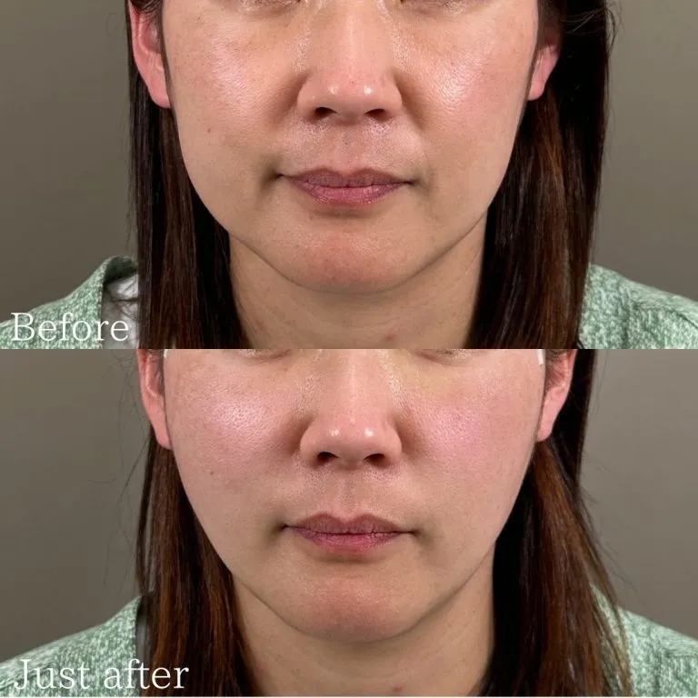 Facial Slimming & Skin Rejuvenation (Lift-Up)
