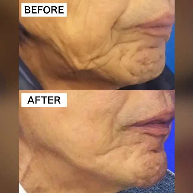 Surgical Facelift