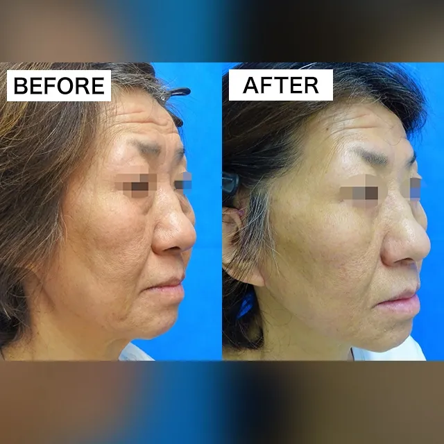 Surgical Facelift