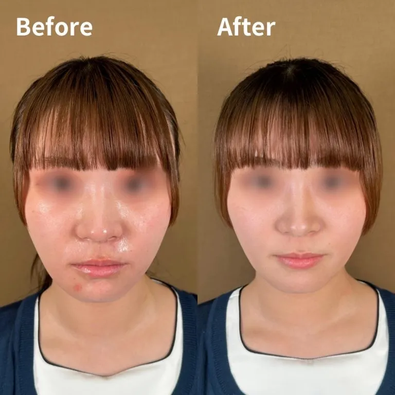 Clear Fine Lift