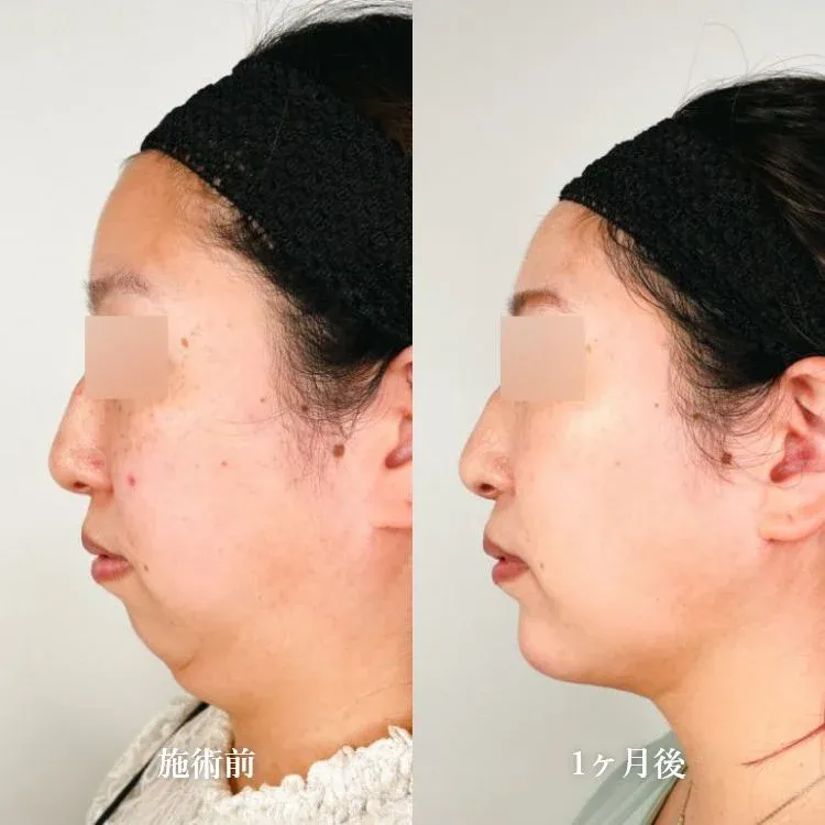 Facial Liposuction
