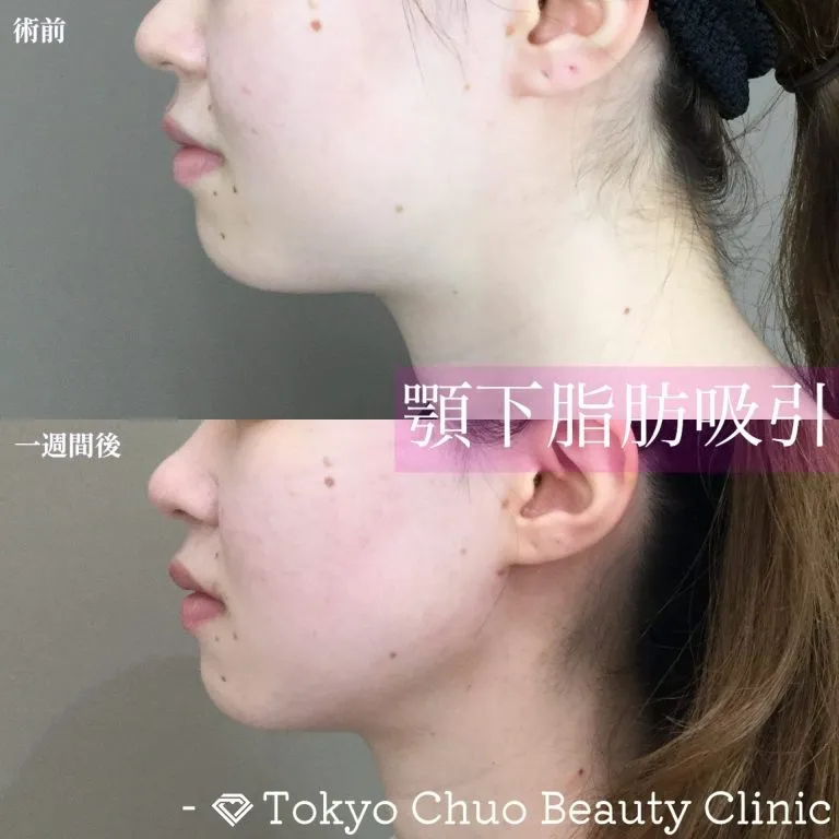 Facial Liposuction