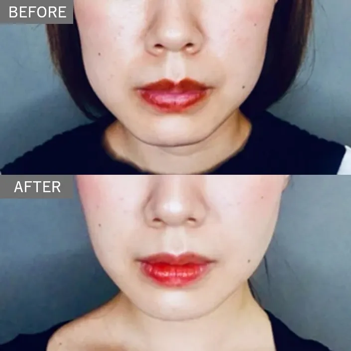 Buccal Fat Removal