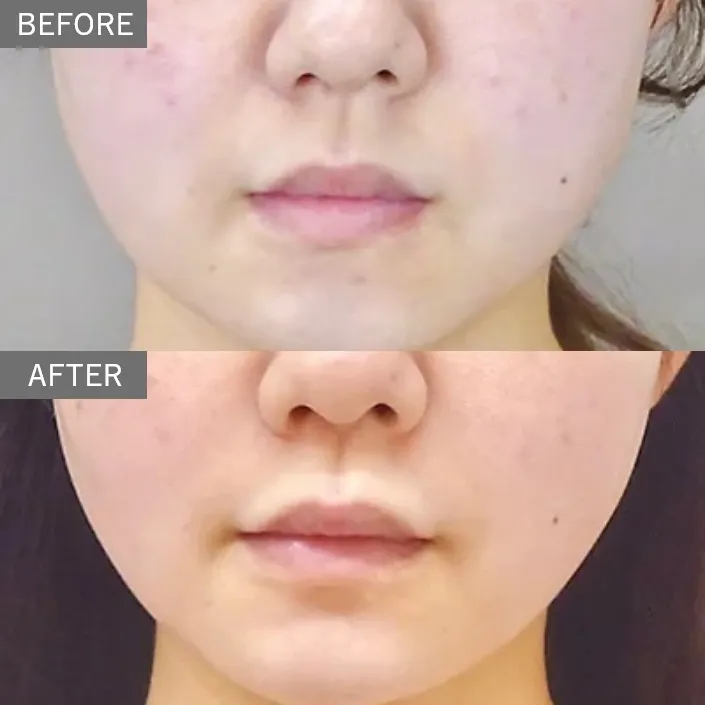 Buccal Fat Removal