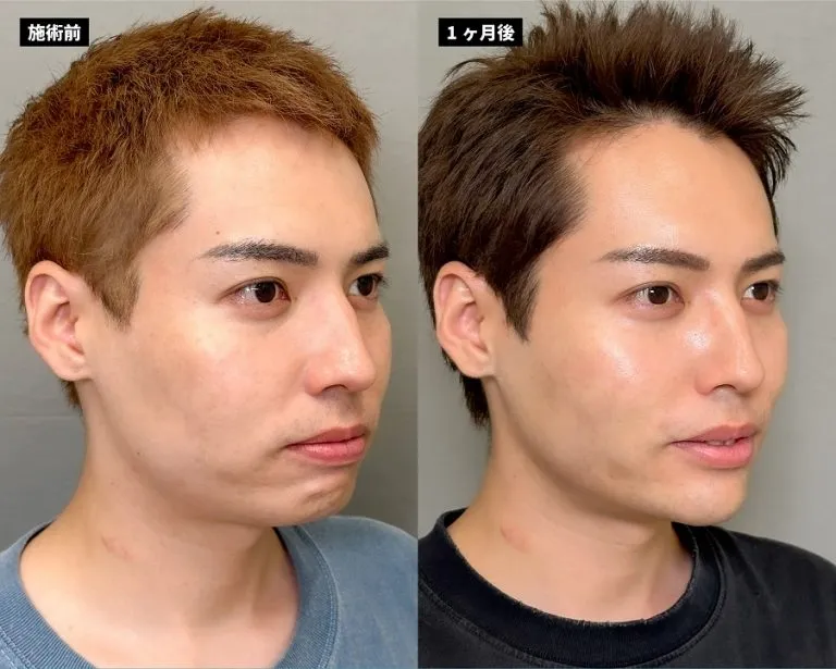 Malar Fat Removal