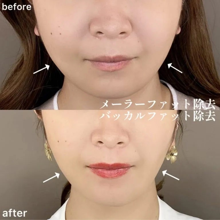 Malar Fat Removal