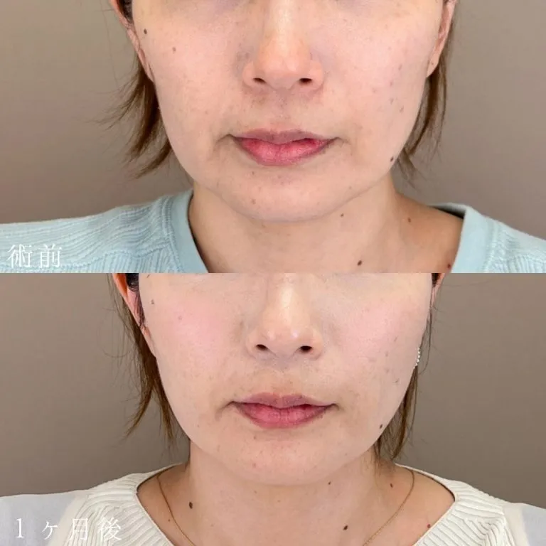 Jowl Fat Removal