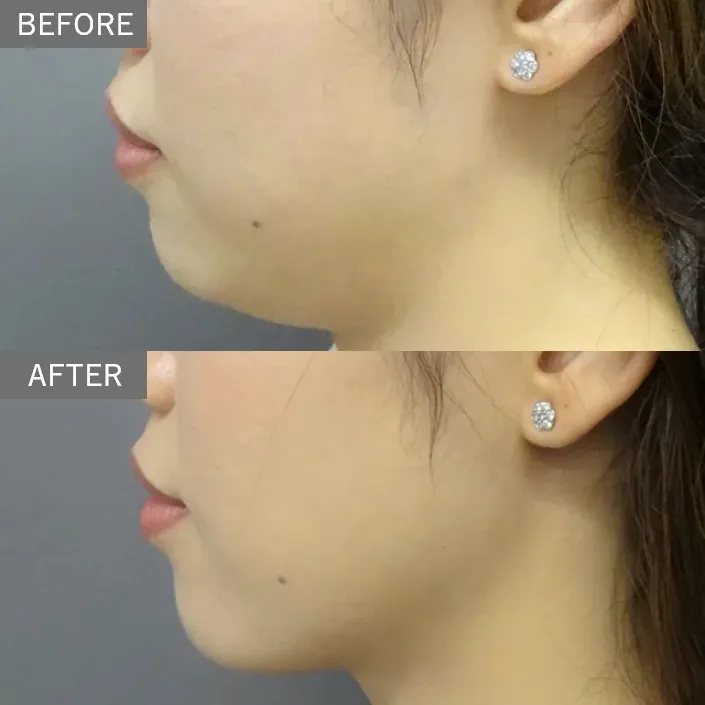 Same-Day Facial Slimming Injection