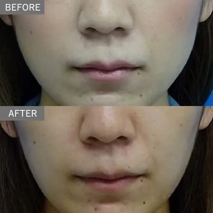 Same-Day Facial Slimming Injection