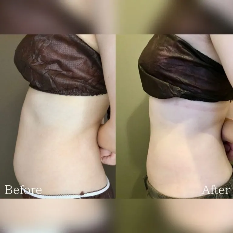 VFDI Fat Dissolving Injection