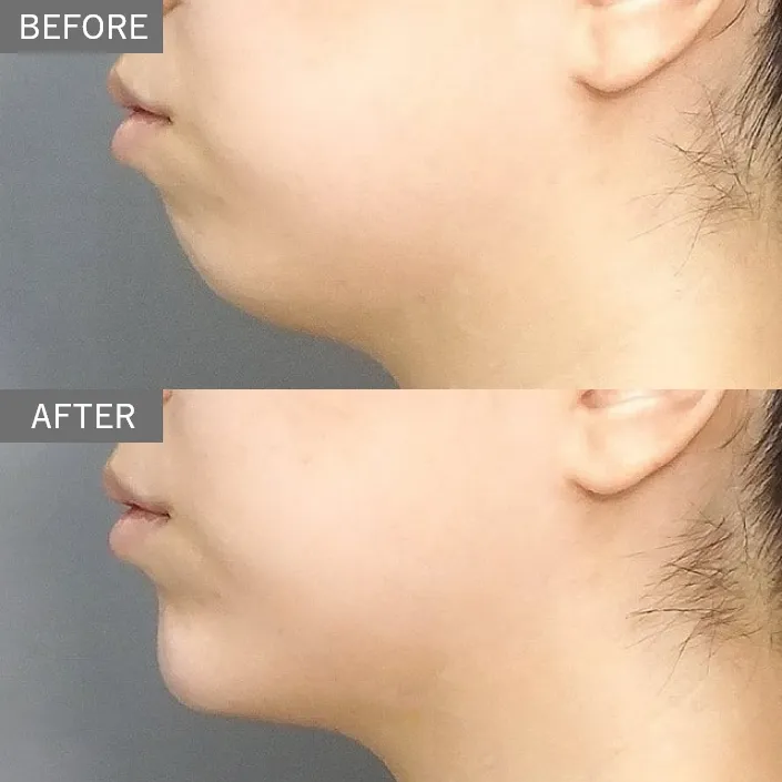 Chin Hyaluronic Acid Injection