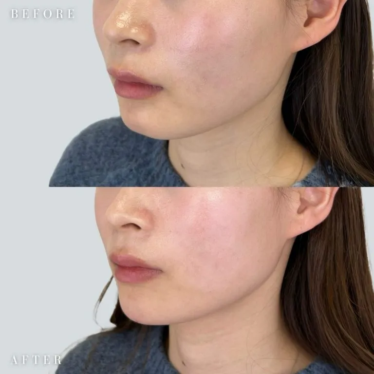 Chin Hyaluronic Acid Injection