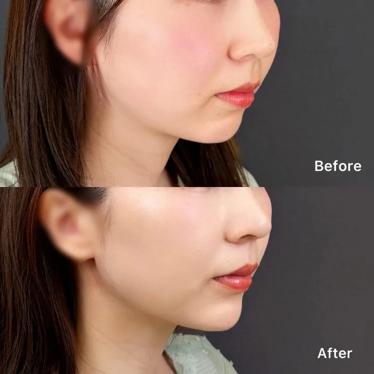 Non-Incisional Chin Contouring 3D E-Line