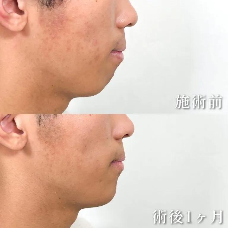 Non-Incisional Chin Contouring 3D E-Line