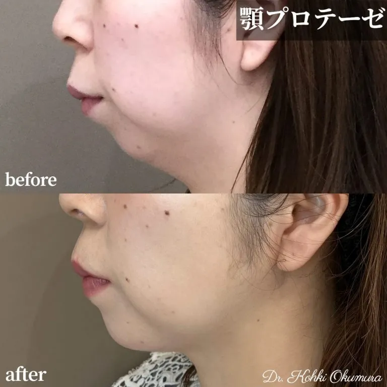 Chin Implant