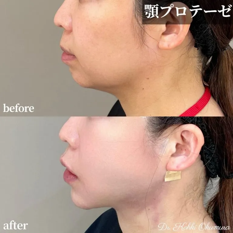 Chin Implant