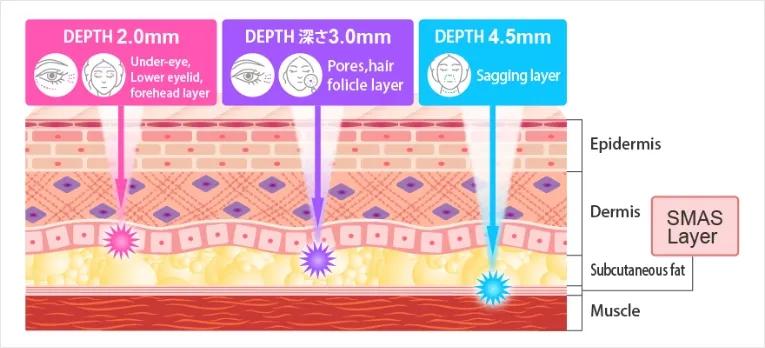 HIFU Effects and Depth Characteristics