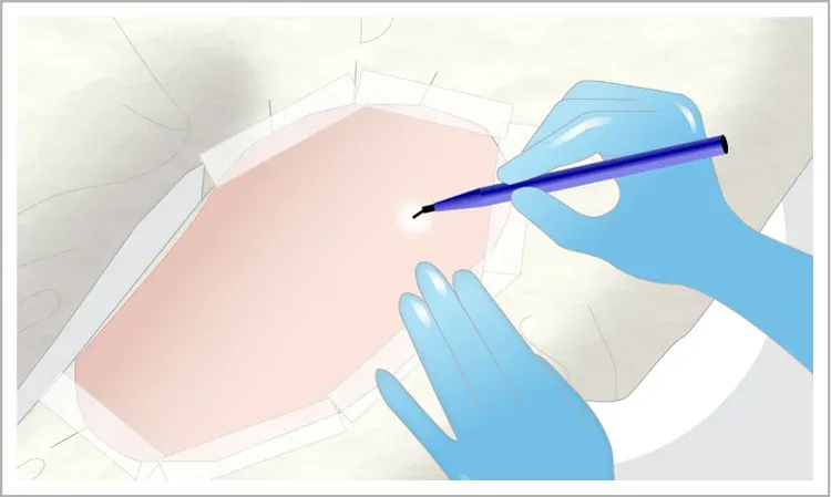 Preparation and Anesthesia Before Fat Harvesting