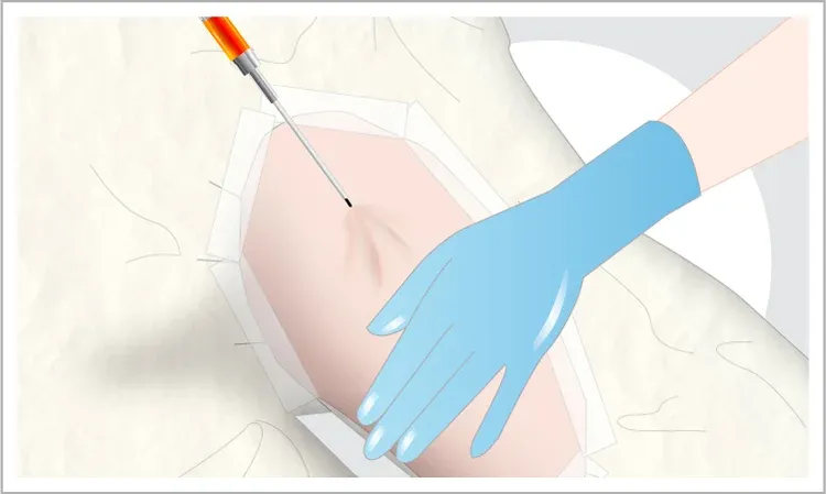 Aspiration Technique and Centrifugation Protocol