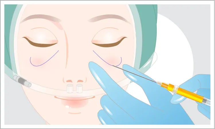 Fat Injection, Symmetry Adjustment, and Final Touches