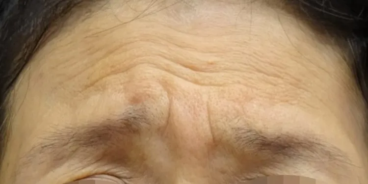 Frown Line Treatment (Hyaluronic Acid)_before
