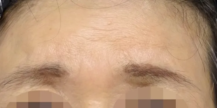Frown Line Treatment (Hyaluronic Acid)_after