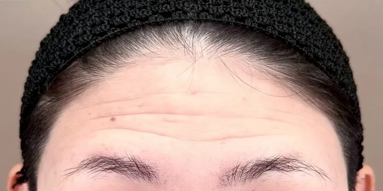 Forehead Wrinkle Treatment (Hyaluronic Acid)_before