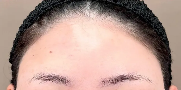 Forehead Wrinkle Treatment (Hyaluronic Acid)_after