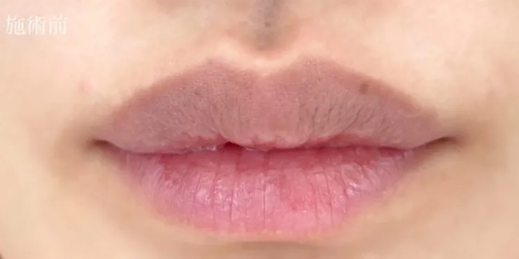 Lip Filler (Hyaluronic Acid Injection)_before