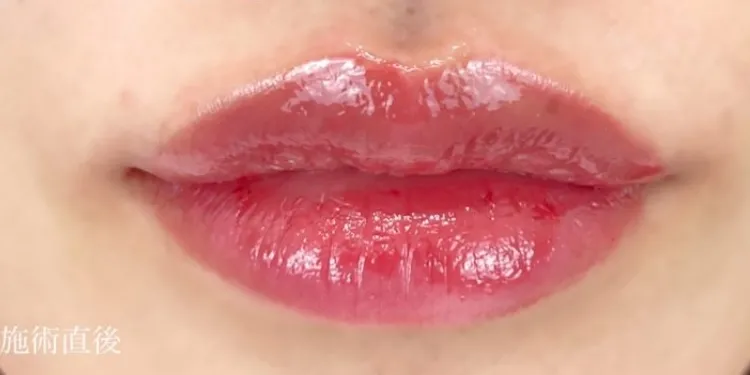 Lip Filler (Hyaluronic Acid Injection)_after