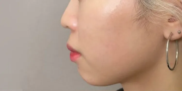 Chin Filler (Hyaluronic Acid Injection)_before