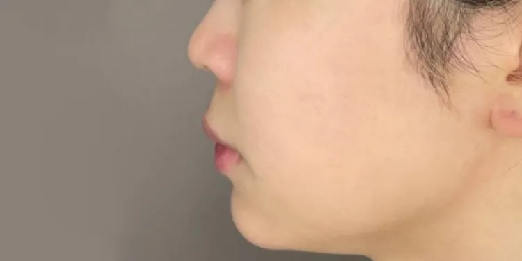 Chin Filler (Hyaluronic Acid Injection)_after