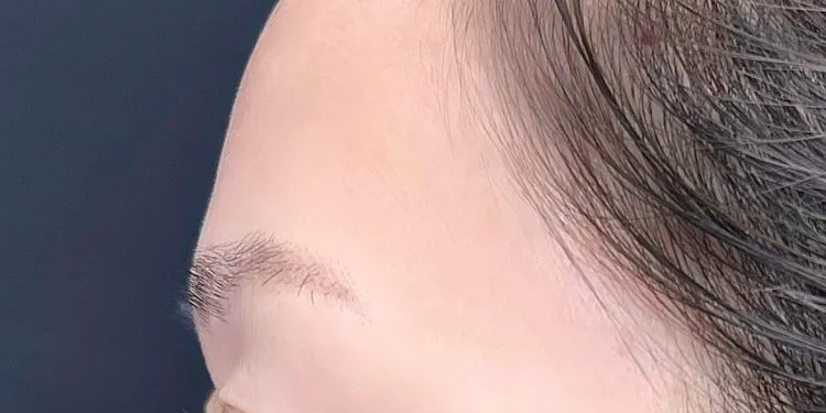Forehead & Temple Contouring Injection (Hyaluronic Acid)_before