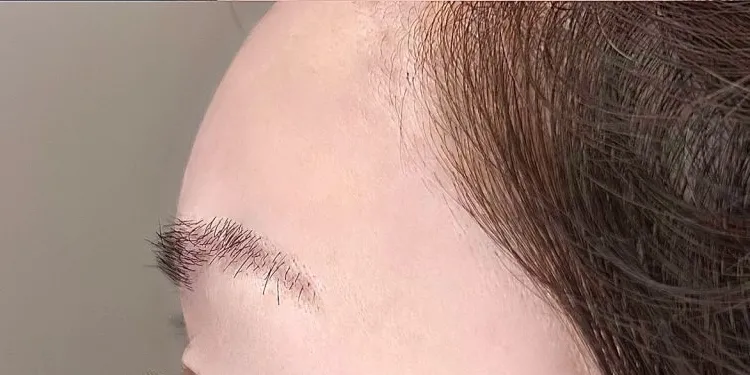 Forehead & Temple Contouring Injection (Hyaluronic Acid)_after
