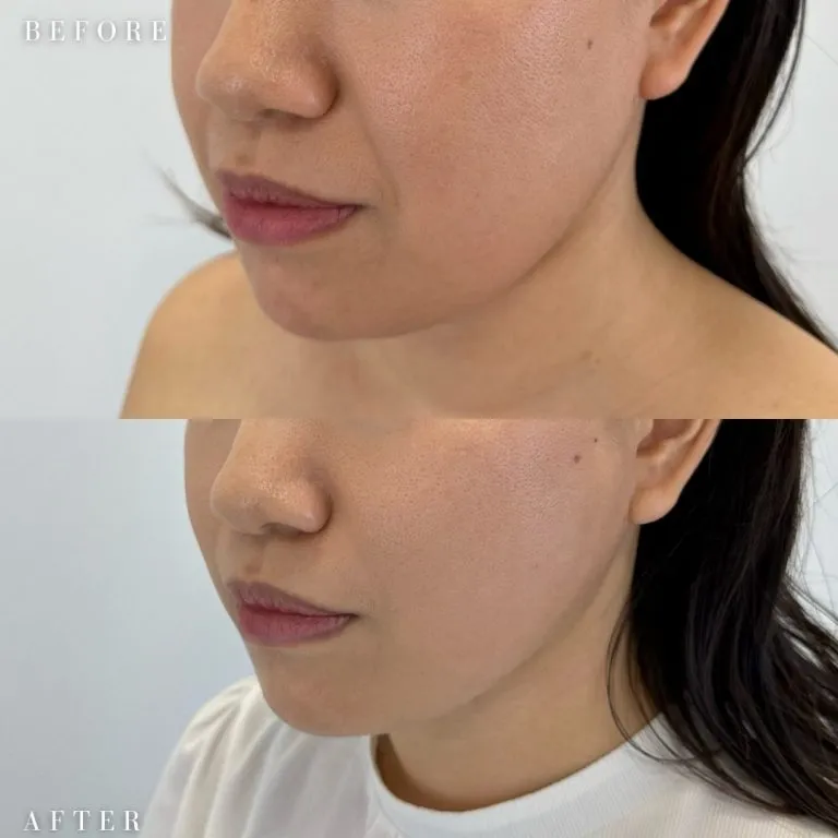 Nasolabial Fold Filler