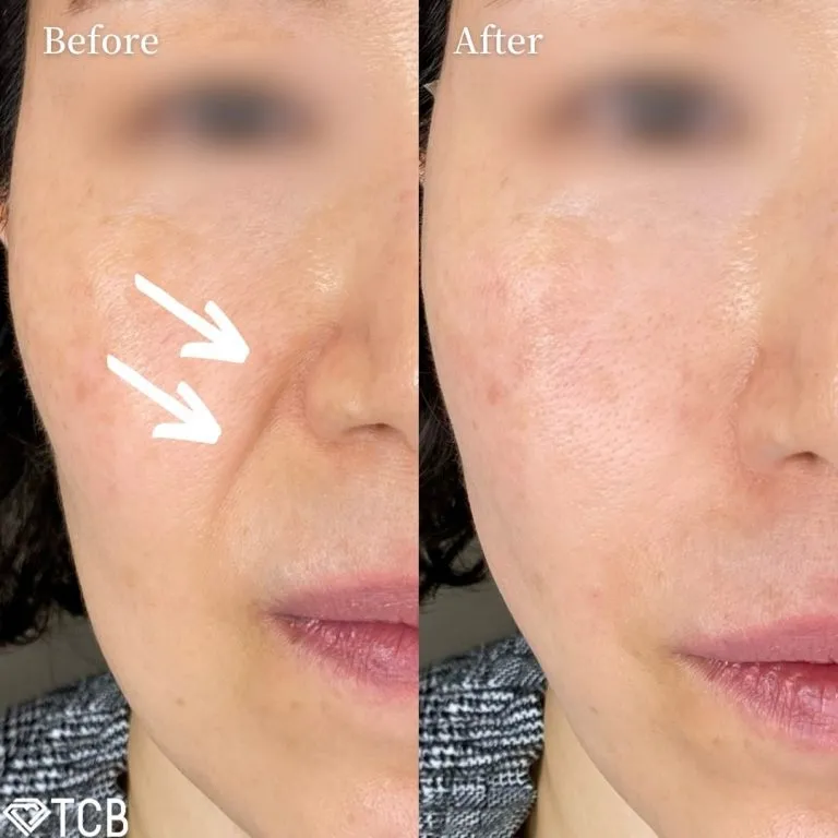 Nasolabial Fold Filler