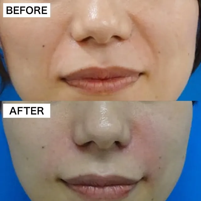 Nasolabial Fold Filler