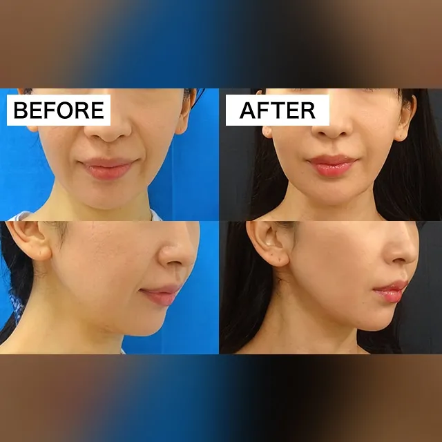 Nasolabial Fold Filler
