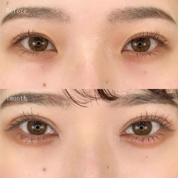 Tear Trough Filler