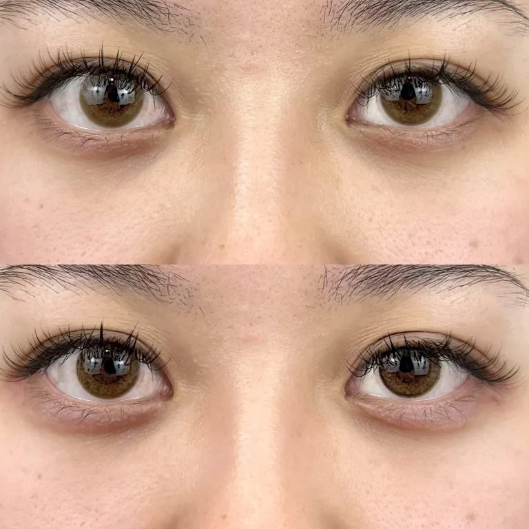 Tear Trough Filler