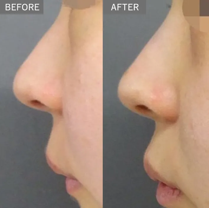 Nose Filler